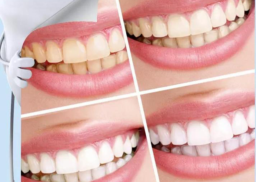 اداة تبيض الاسنان